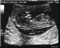 EQUIPO OBSTETRICO
Unidad Perinatal
Diagnstico Pre-Natal
Tamizaje prenatal de defectos congnitos
TRANSLUCENCIA NORMAL