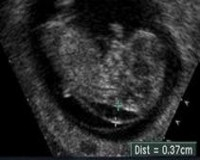 EQUIPO OBSTETRICO
Unidad Perinatal
Diagnstico Pre-Natal
Tamizaje prenatal de defectos congnitos
TRANSLUCENCIA ANORMAL