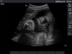 EQUIPO OBSTETRICO
Unidad Perinatal
Ecograf�as
Calendario de Ecograf�as
CARA FETAL, NARIZ, LABIO SUP. OJO